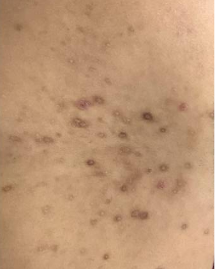 Day 0 – 20 days