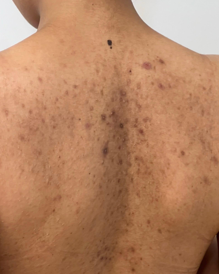 Day 0 – 30 days