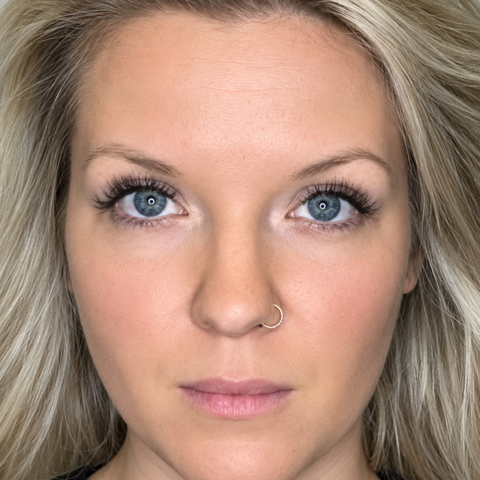 Day 7 – Forehead lines  · 7 days